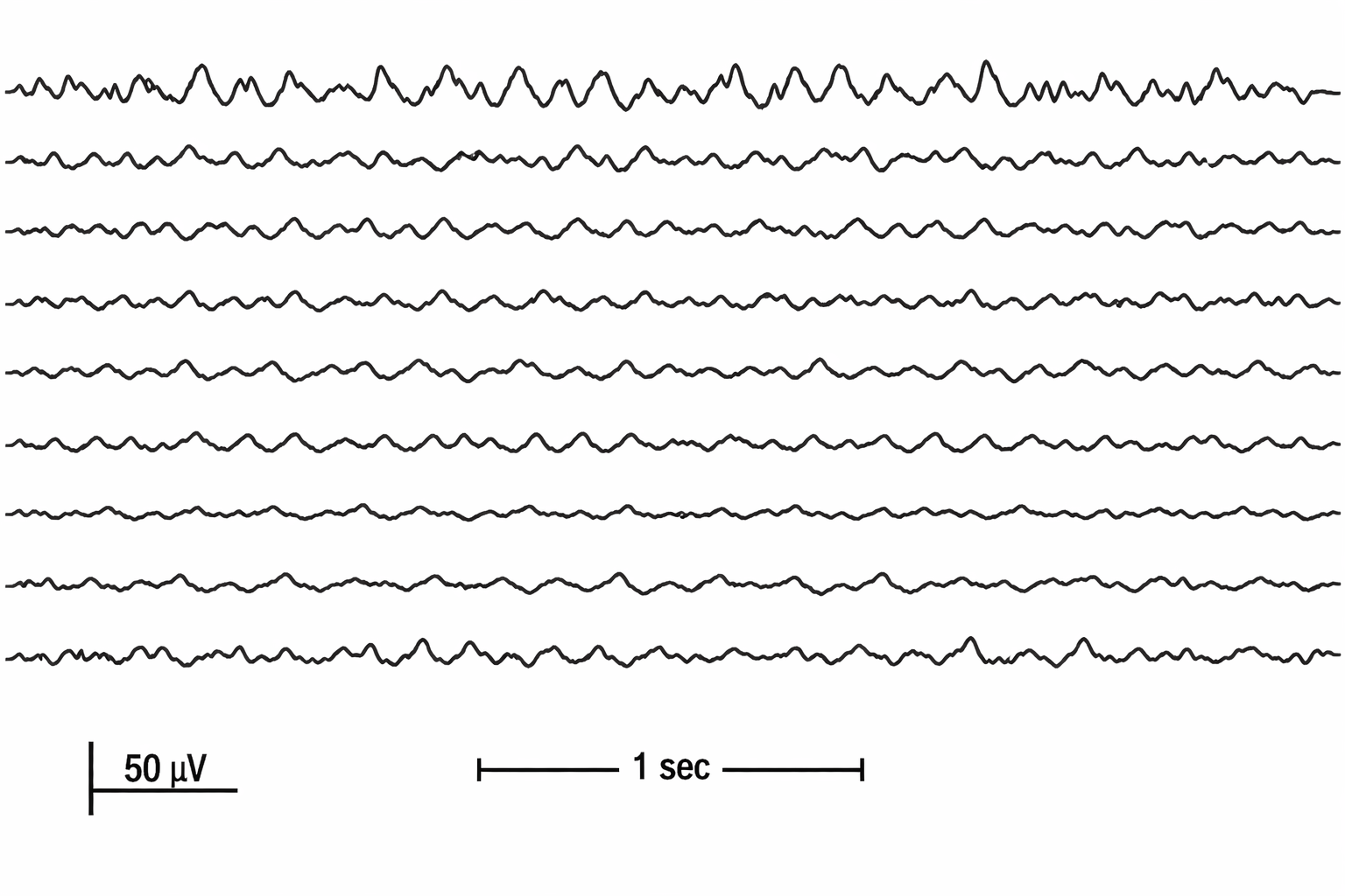 Calm coherent brain waves after patch