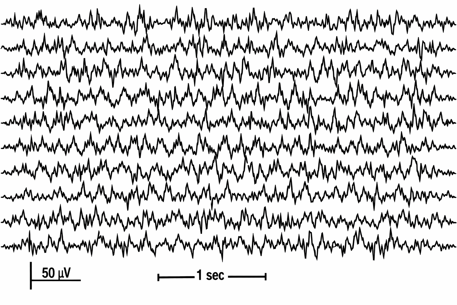 Chaotic brain waves before patch